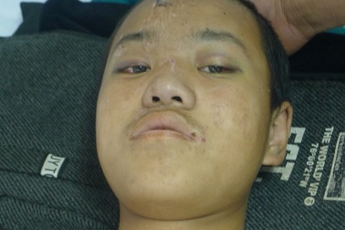 Không có 60 triệu mổ cột sống, cậu bé 12 tuổi mồ côi cha mẹ có nguy cơ liệt vĩnh viễn