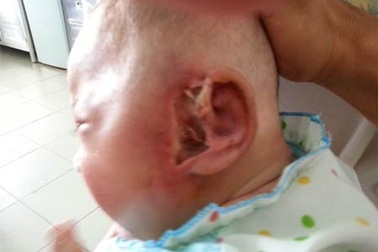 Bé 5 tháng tuổi bị giòi ăn mất ống tai