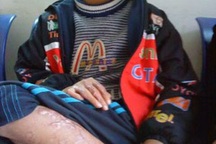 Nỗi đau của cậu bé bị anh họ thiêu đốt