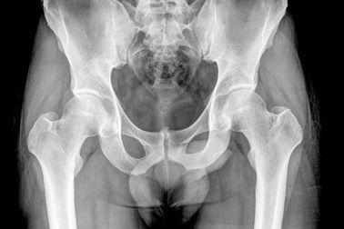 Hi hữu bào thai hóa đá 50 năm trong bụng cụ bà