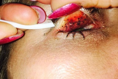 Kinh hoàng u đen chi chít trong mắt vì lười tẩy trang