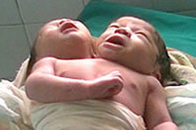 Cặp song sinh đặc biệt bị nhiễm trùng máu