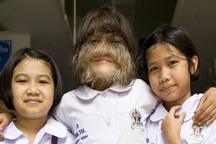 Cuộc sống của cô bé "người sói" từng nổi tiếng thế giới giờ ra sao?