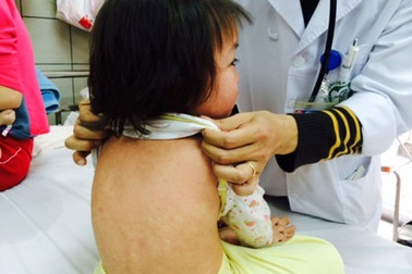 Đã có 3 trẻ tử vong do sởi