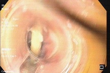 Mảnh xương gà 3 cm mắc ngang thực quản người bệnh