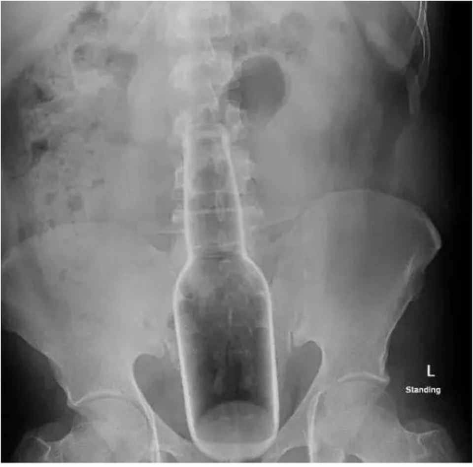 Gãi ngứa quá đà, chui tọt chai nước vào trực tràng - 2