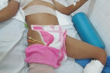 Gia cảnh éo le của người đàn ông bị điện phóng bỏng toàn thân 