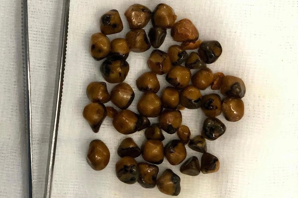 Hơn 40 viên sỏi được lấy ra trong túi mật nữ bệnh nhân 51 tuổi - 1