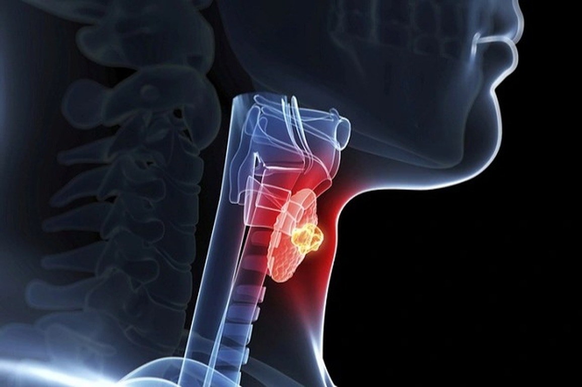 Phát hiện u tuyến giáp lành tính có cần phẫu thuật? - 1 Phát hiện u tuyến giáp lành tính có cần phẫu thuật? - 1