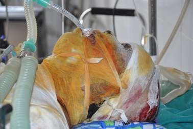 Em Đỗ Văn Nghĩa bị bỏng nặng đã qua đời