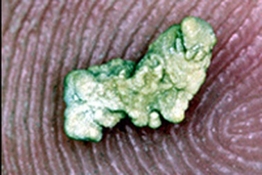 Điều trị sỏi thận bằng vi khuẩn