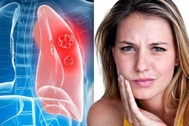 Thấy dấu hiệu này trên mặt, bạn nên đi khám ung thư phổi