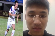 Cầu thủ SL Nghệ An đấm gãy mũi đối thủ nhận án phạt nặng