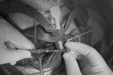 Người đàn ông nhập viện với chiếc đinh vít kẹt trong niệu đạo