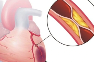 Bệnh nhân "nghiện" chụp mạch vành, chi tiền triệu xin chụp vẫn bị từ chối