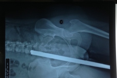 Ngã xe, nữ sinh bị thanh sắt đâm xuyên mông