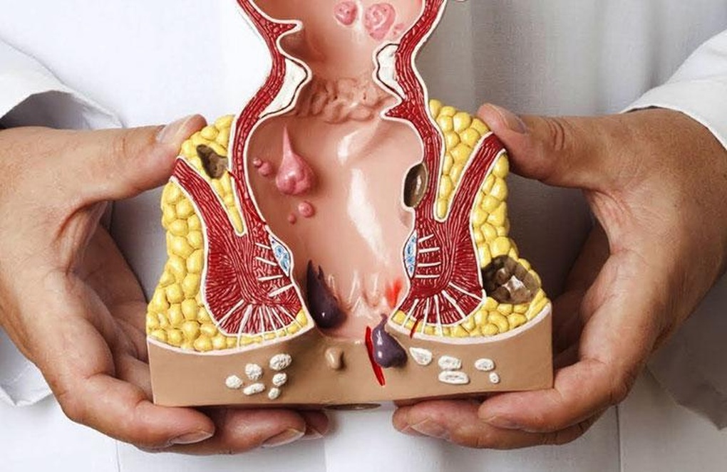 Những lưu ý khi bị bệnh trĩ bạn cần biết - 1 Những lưu ý khi bị bệnh trĩ bạn cần biết - 1