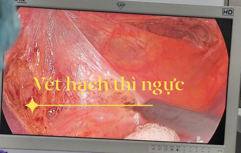 Ung thư thực quản có thể chữa khỏi nếu phát hiện sớm - 3 Ung thư thực quản có thể chữa khỏi nếu phát hiện sớm - 3