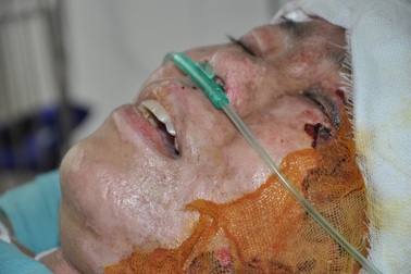 Nổ gas kinh hoàng, người mẹ trẻ nguy kịch tính mạng