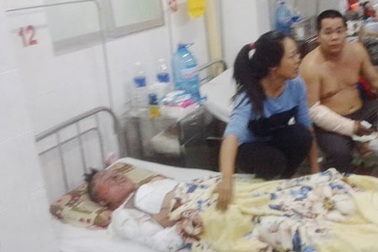 Bỏng nặng do vừa hút thuốc vừa rút xăng