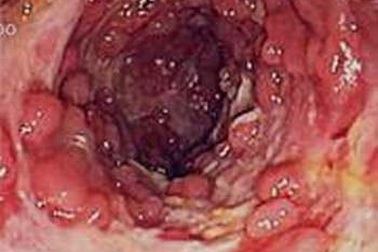 Bị ung thư lại ngỡ viêm dạ dày