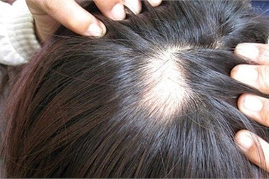 Xài ‘thần dược’ chống hói, lông lá mọc đầy người