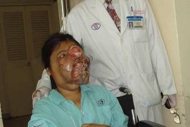 Bóc tách thành công khối u nặng 1,3kg trên mặt thiếu nữ