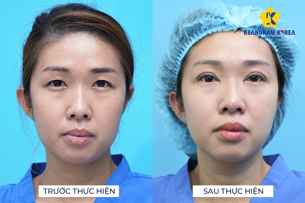 Hơn 500.000 ca thành công khơi dậy sức sống cho mắt tại Keangnam Korea - 1 Hơn 500.000 ca thành công khơi dậy sức sống cho mắt tại Keangnam Korea - 1