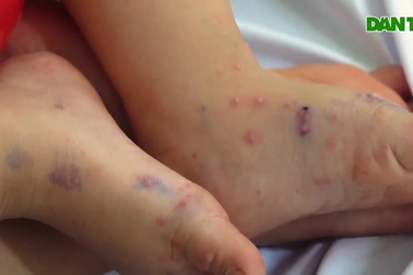 Xếp hàng đưa con đi khám bệnh tay chân miệng ở TPHCM