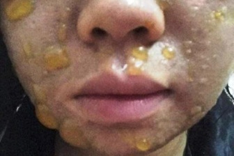 Nhiều người nhập viện vì mặt sưng húp, sạm đen sau peel da theo mạng xã hội