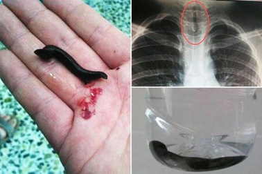 Kêu đau họng và choáng, tìm thấy đỉa kẹt trong đường thở