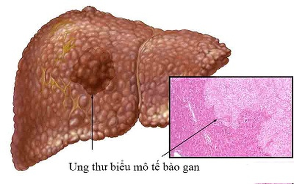 Liệu pháp mới giúp kéo dài cuộc sống bệnh nhân ung thư gan giai đoạn muộn - 1 Liệu pháp mới giúp kéo dài cuộc sống bệnh nhân ung thư gan giai đoạn muộn - 1