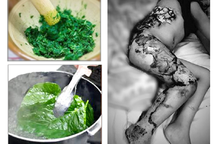 Bé trai chết tức tưởi vì gia đình điều trị bỏng bằng… lá cây