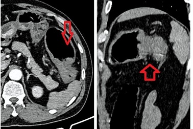 Cảnh báo ung thư đại tràng từ những dấu hiệu tưởng thông thường