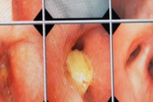 Người phụ nữ nguy kịch vì... một miếng xoài