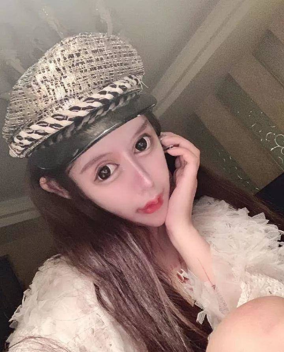 Gương mặt biến dạng của hotgirl nghiện dao kéo thẩm mỹ từ năm 13 tuổi - 6 Gương mặt biến dạng của hotgirl nghiện dao kéo thẩm mỹ từ năm 13 tuổi - 6