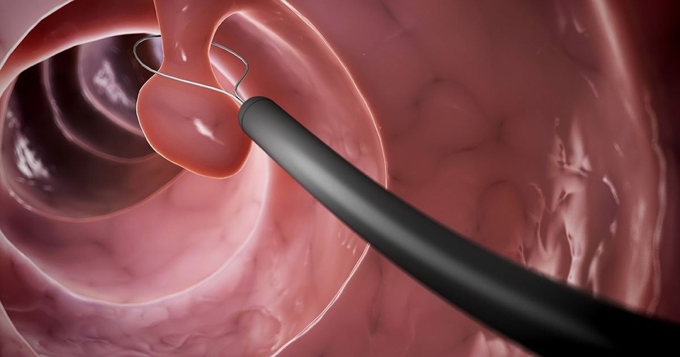 Nhận biết dấu hiệu polyp đại tràng như thế nào? - 1 Nhận biết dấu hiệu polyp đại tràng như thế nào? - 1
