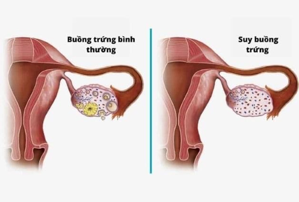 Khám tiền hôn nhân, cô gái 24 tuổi phát hiện bị suy buồng trứng sớm - 1 Khám tiền hôn nhân, cô gái 24 tuổi phát hiện bị suy buồng trứng sớm - 1