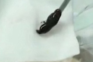 Đỉa nở trứng, sống 3 tháng trong lỗ mũi chàng trai trẻ