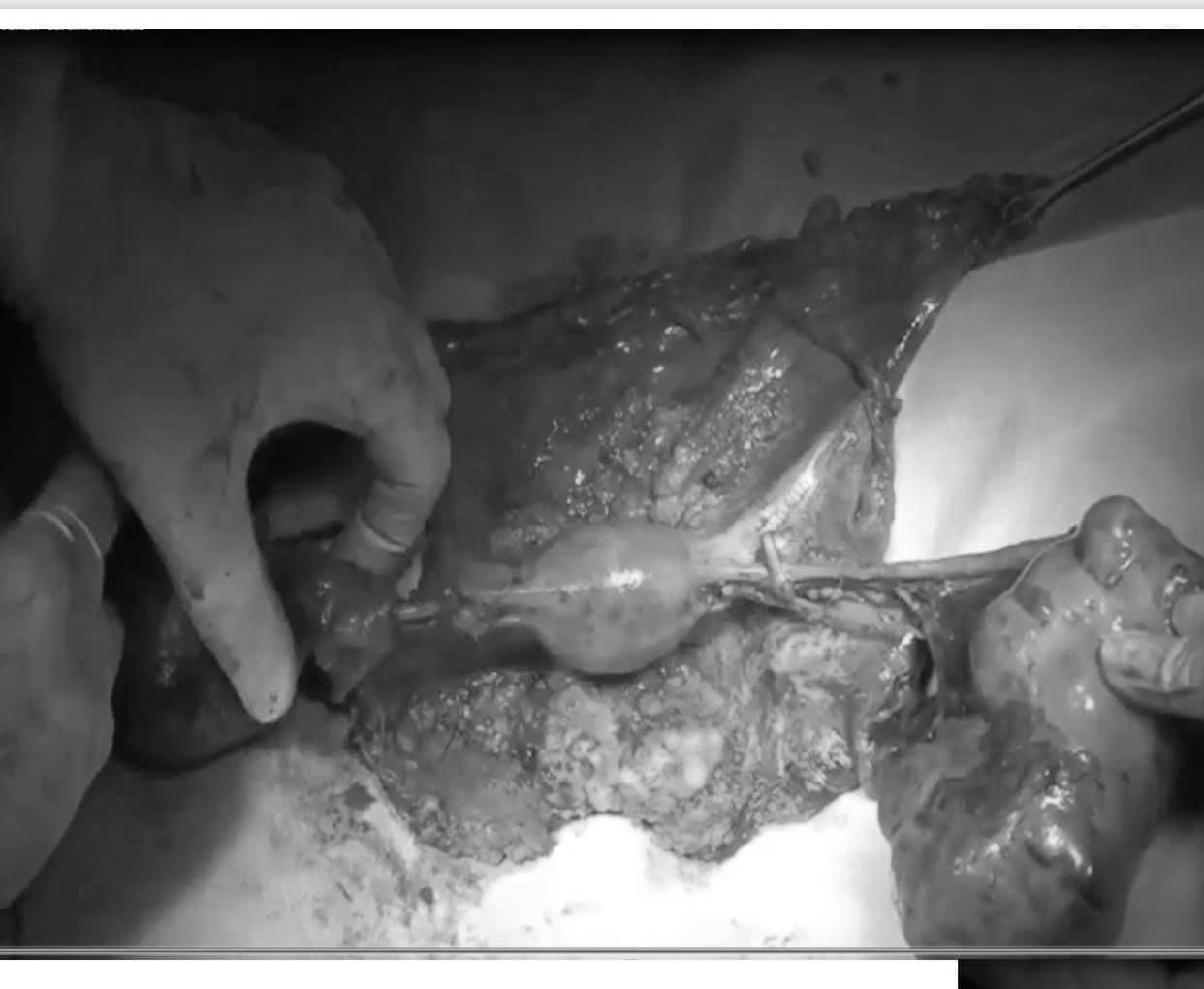 Đoạn chậu toàn phần cứu bệnh nhân ung thư cổ tử cung tái phát - 1 Đoạn chậu toàn phần cứu bệnh nhân ung thư cổ tử cung tái phát - 1