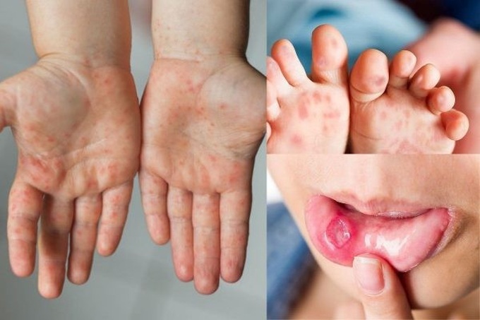 Trong 2 tuần gần đây, số ca mắc tay chân miệng tại thành phố Hà Nội khoảng 140 ca/tuần. Ảnh minh họa