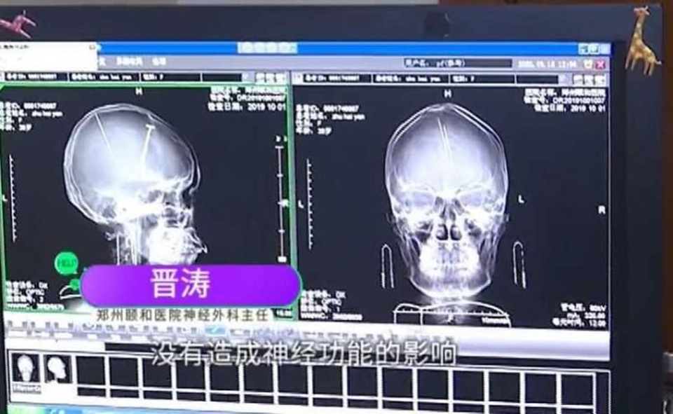 Đến bệnh viện sau va chạm giao thông, không ngờ phát hiện vật lạ cắm sâu trong não - 2 Đến bệnh viện sau va chạm giao thông, không ngờ phát hiện vật lạ cắm sâu trong não - 2