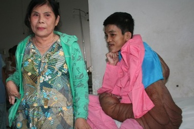 Thêm 10 triệu đồng tiếp sức cho “dị nhân” bướu khổng lồ