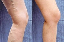 Mạch máu biến dạng vì đứng 8-12 tiếng mỗi ngày