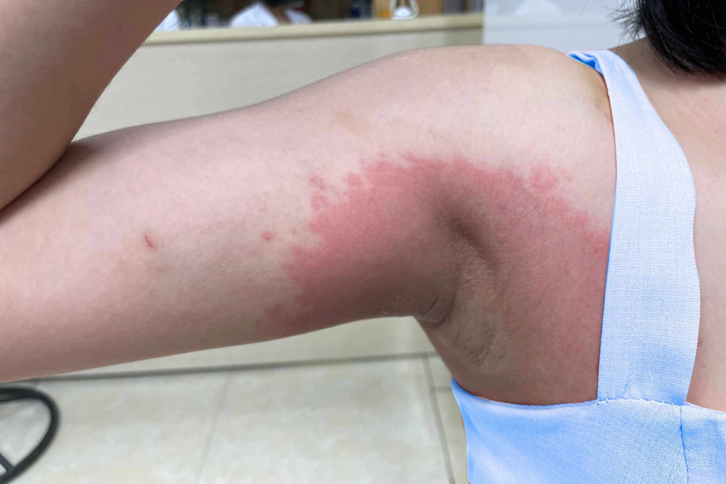 Hà Nội: Cô gái sốc nặng vì nách đổi màu sau khi lột da tại spa - 1 Hà Nội: Cô gái sốc nặng vì nách đổi màu sau khi lột da tại spa - 1