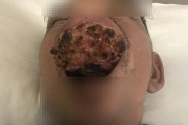 Vết loét vòm miệng cảnh báo ung thư