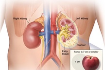 Ung thư biểu mô tế bào thận là gì?