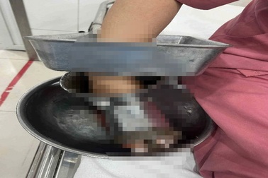 Nữ đầu bếp bị tai nạn nghiêm trọng khi sử dụng máy xay thịt