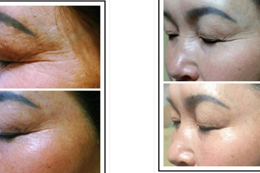 Transfer Double Nanosphere – Công nghệ siêu trẻ hóa da Hàn Quốc