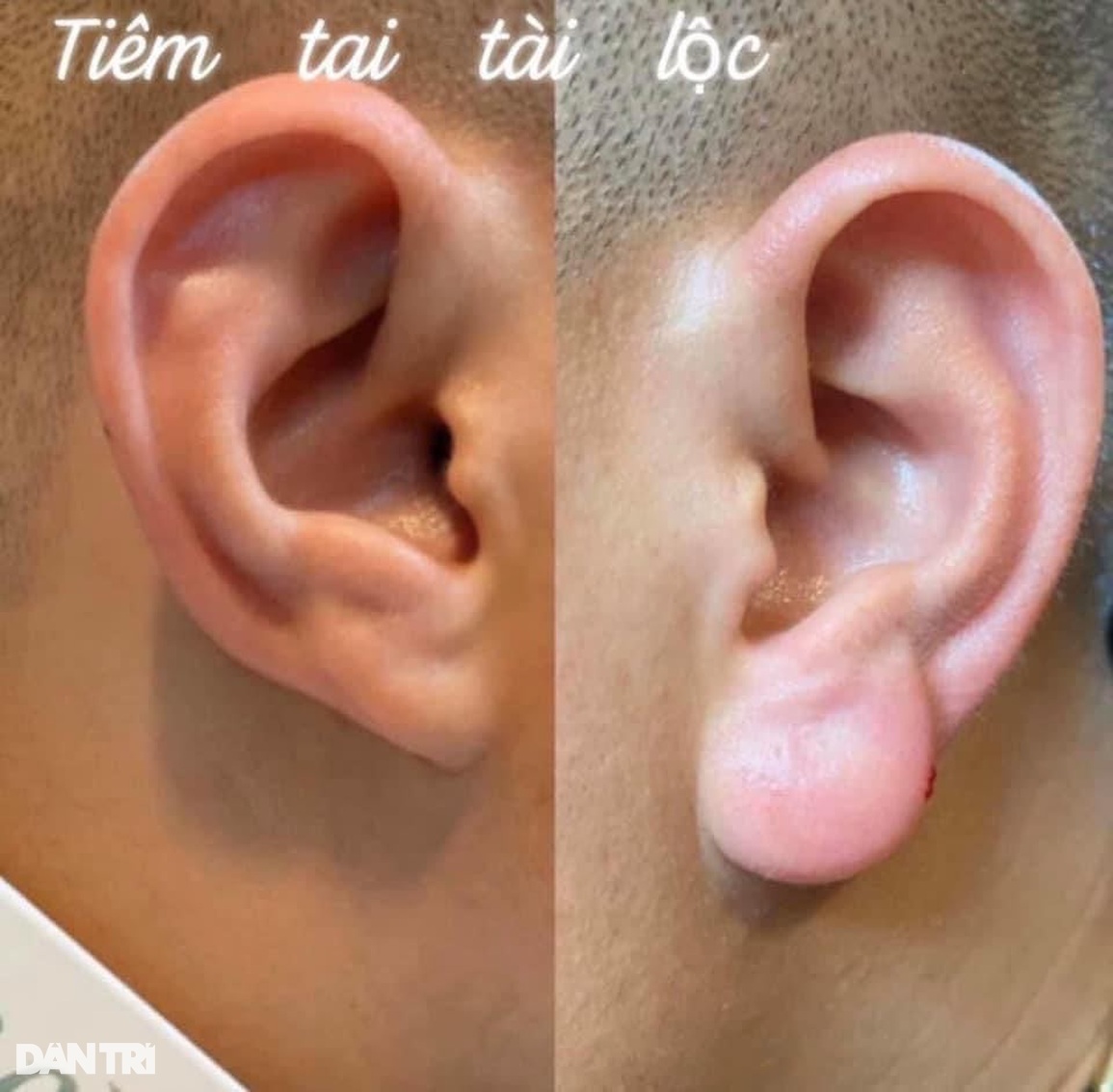 Lạ lùng trào lưu đàn ông đua nhau đi tiêm tai Phật Di Lặc - 2 Lạ lùng trào lưu đàn ông đua nhau đi tiêm tai Phật Di Lặc - 2